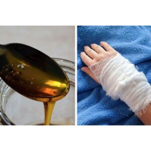 🟡 مکانیسم اثر عسل بر روی زخم