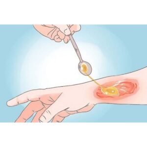 چگونه عسل را روی زخم باز بگذاریم؟ (آموزش مرحله به مرحله و کاملاً اصولی)